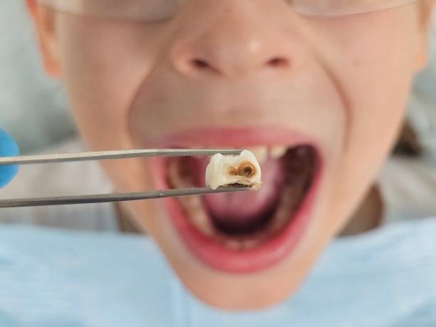 Best Broken or Cracked Tooth Emergency Dentist in Chelsea, MA
