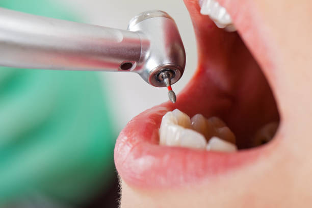 Best Emergency Root Canal Treatment in Chelsea, MA